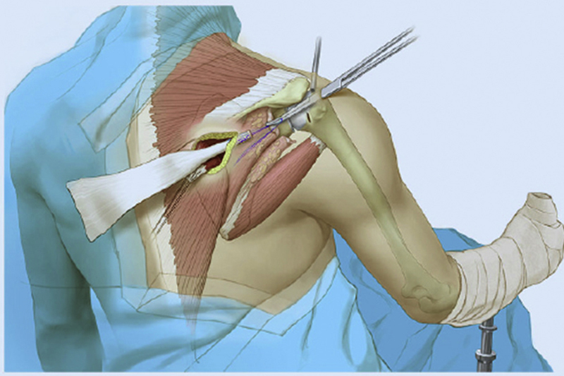 Scope-assisted Lower Trapezius Transfer (SALT procedure) Pic 1