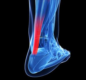 Achilles/Ankle Injuries