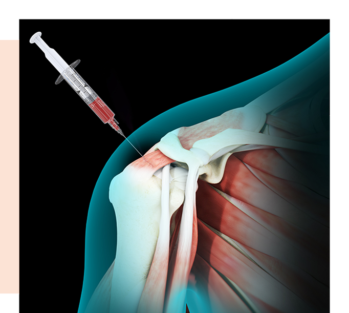 Bone Marrow Aspirate Concentrate Images