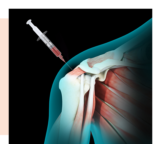 Bone Marrow Aspirate Concentrate Images