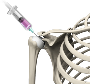 Intraarticular Shoulder Injection