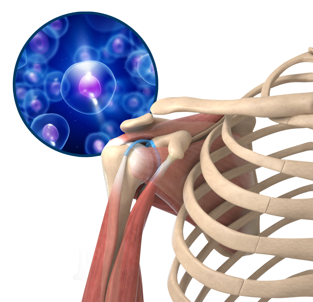 Orthobiologics Treatment for the Shoulder