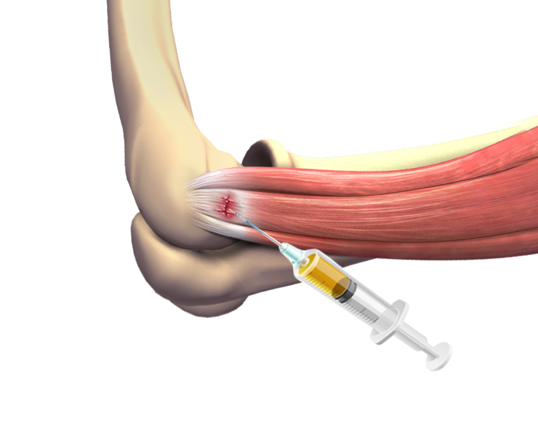 Platelet-Rich Plasma (PRP) for the Elbow