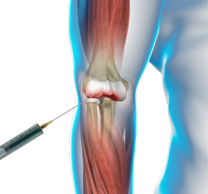 Viscosupplementation for Elbow Arthritis