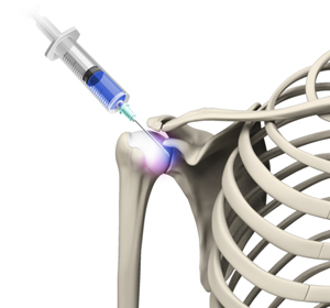 Viscosupplementation for Shoulder Arthritis