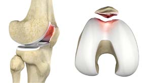 Chondromalacia Patella pic