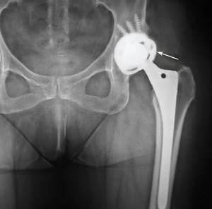 Complex Primary Hip Replacement pic