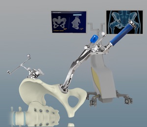 Computer-Navigated Total Hip Replacement pic