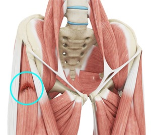 Hip Muscle Strain pic
