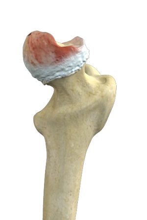 Hip Osteonecrosis pic