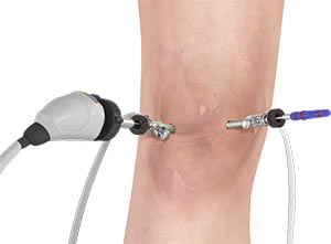 Knee Arthroscopy pic