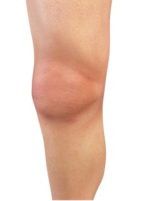 Knee Effusion pic