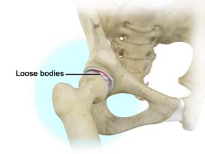 Loose Bodies in the Knee pic