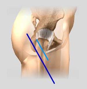 Minimally Invasive Total Hip Replacement pic