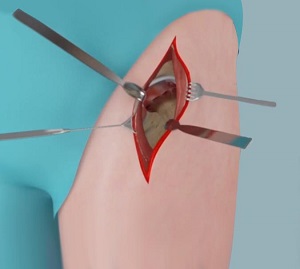 Muscle Sparing Robotic Assisted Hip Replacement pic