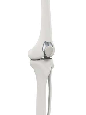 Patellofemoral Knee Replacement pic