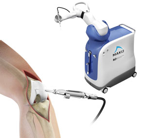Robotic Assisted Knee Replacement pic