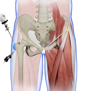 Trochanteric Bursitis pic