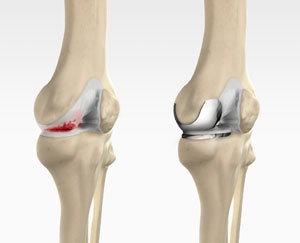 Unicondylar knee Replacement pic