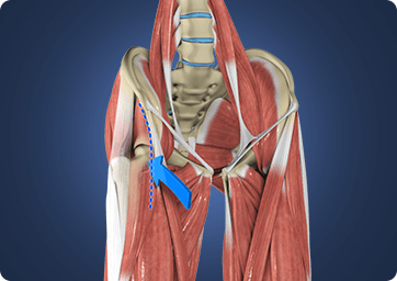 Direct Anterior Hip Replacement