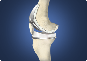 Jiffy KneeTM Joint Replacement