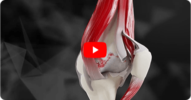 Jiffy Knee Replacement vs Traditional Knee Surgery
Faster Recovery, Less Pain
