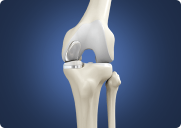 Partial Knee Replacement