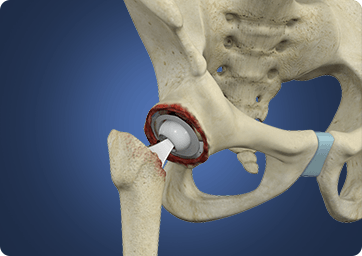 Revision Arthroplasty