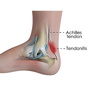 Ankle Tendonitis