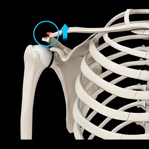 Acromioclavicular Joint Dislocation pic