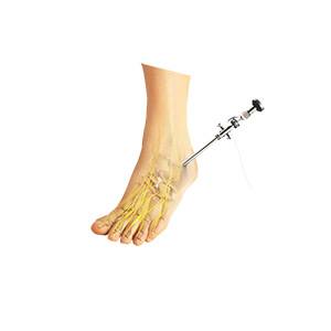 Ankle Arthroscopy