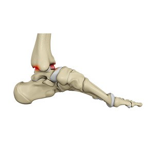 Ankle Impingement