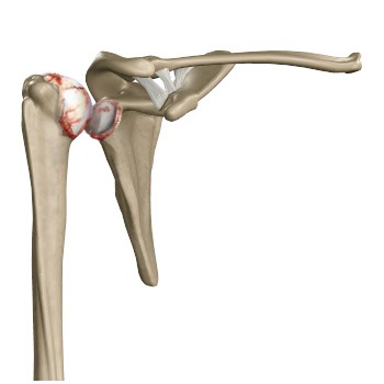 Arthritis of the Shoulder