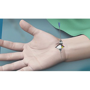 Carpal Tunnel Release Surgery
