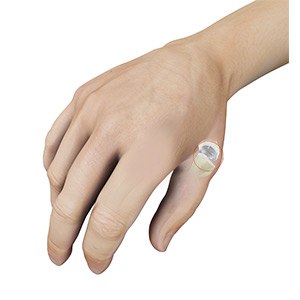 Cartiva Implant for the Thumb