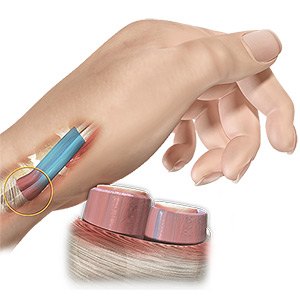 De Quervain's Tendinosis