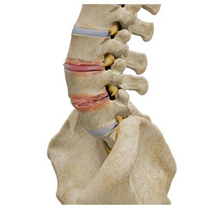 Degenerative Disc Disease 