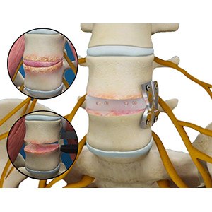 Degenerative Spine Surgery