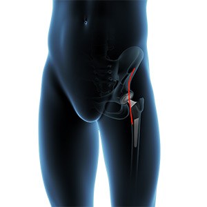 Direct Anterior Hip Replacement