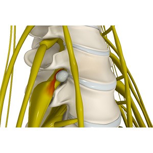 Disc Herniation