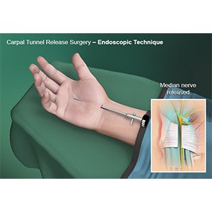 Endoscopic Carpal Tunnel Surgery