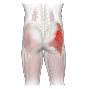 Gluteal Strain