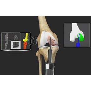 Mako Robotic Knee Replacement