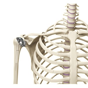 Minimally Invasive Shoulder Joint Replacement