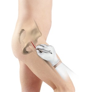 Minimally Invasive Total Hip Replacement