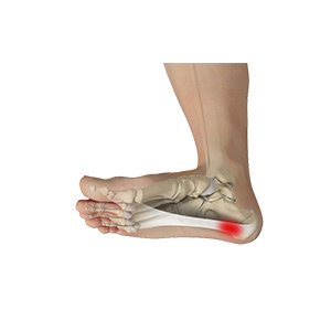 Plantar Fasciitis