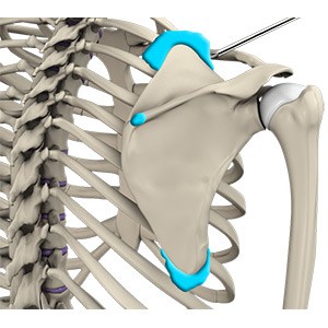 Scapulothoracic Arthroscopy
