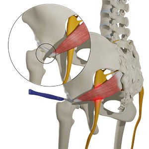 Sciatic Nerve Decompression