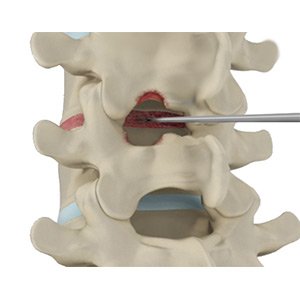 Spinal Decompression
