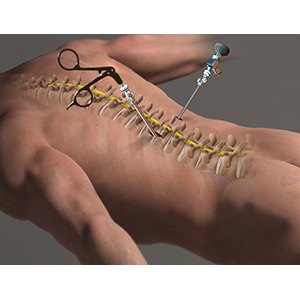 Spine Surgery
